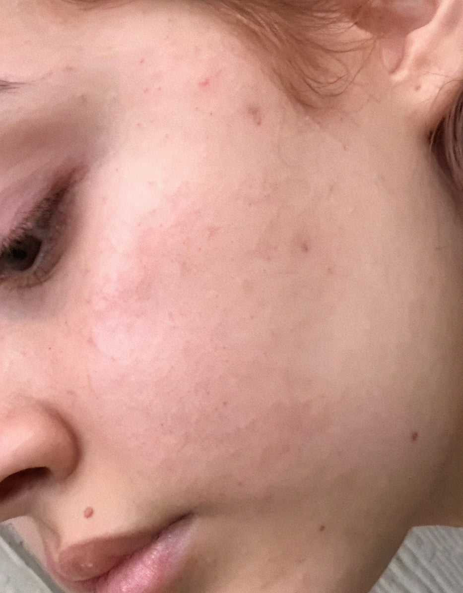 After treatment