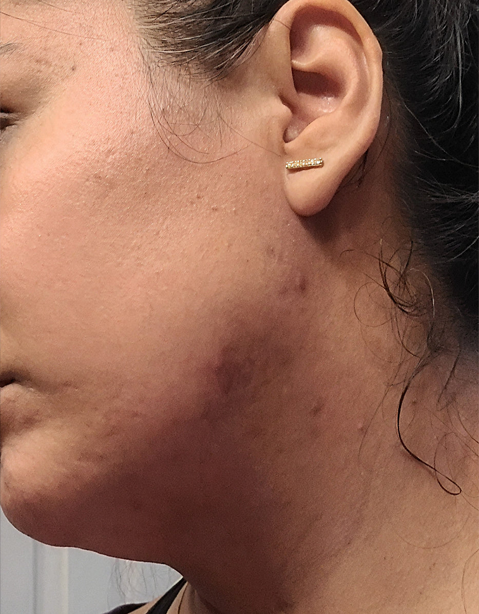 After treatment