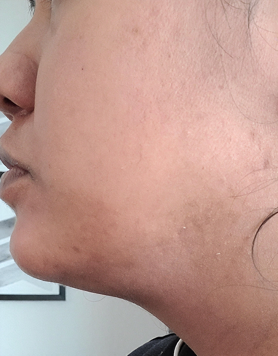 Before treatment